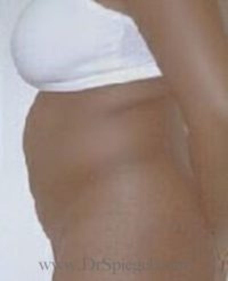Tummy Tuck Before & After Gallery - Patient 157140758 - Image 1