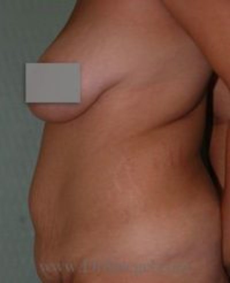 Tummy Tuck Before & After Gallery - Patient 157140767 - Image 1