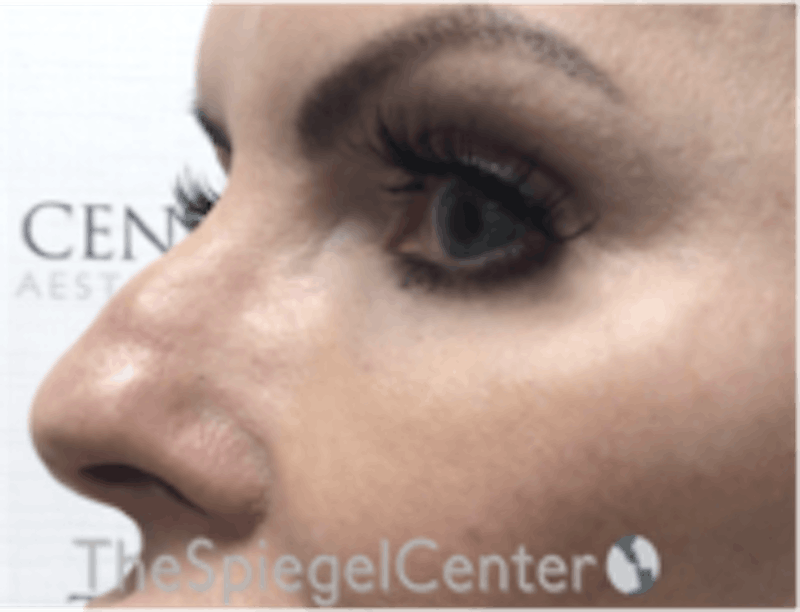 Tear Trough / Under Eye Fillers Before & After Gallery - Patient 157140769 - Image 3
