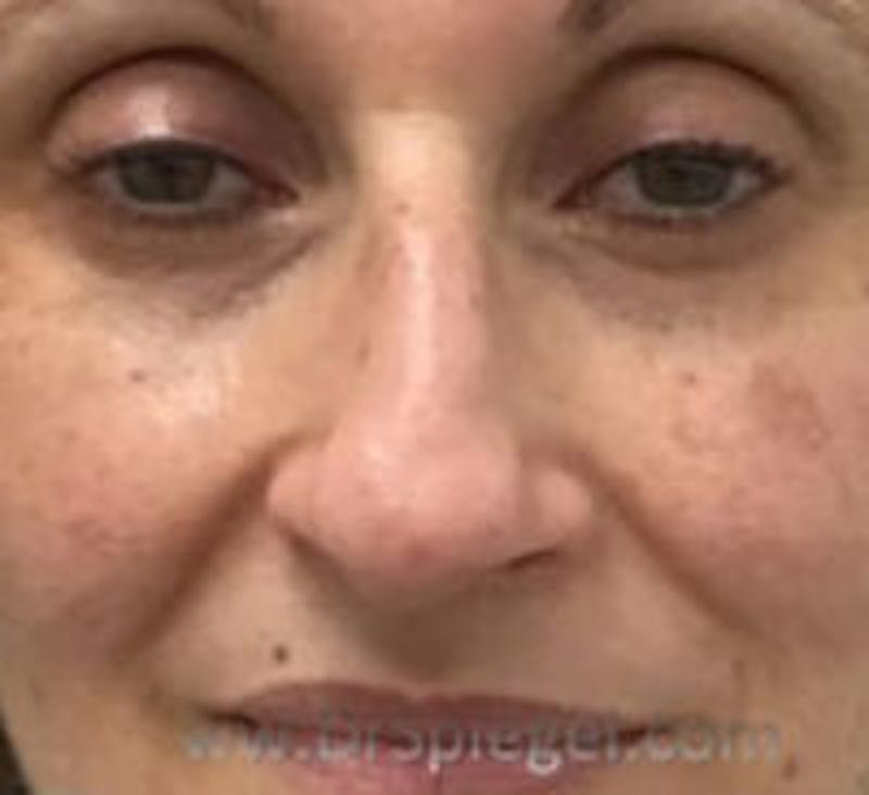 Non-Surgical Rhinoplasty / Nose Filler Before & After Gallery - Patient 157140770 - Image 1