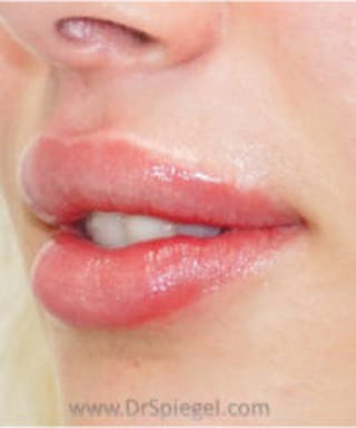 Lip Filler Before & After Gallery - Patient 157140766 - Image 4