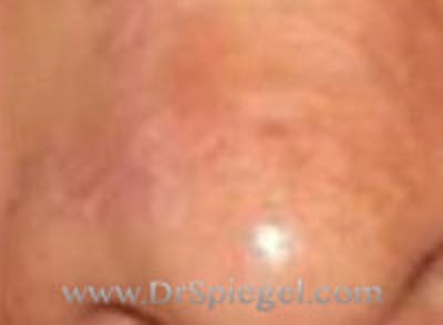 Scar Revision Before & After Gallery - Patient 157140765 - Image 2