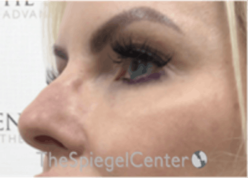 Tear Trough / Under Eye Fillers Before & After Gallery - Patient 157140769 - Image 4
