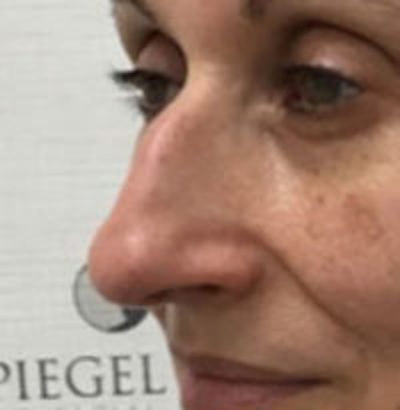Non-Surgical Rhinoplasty / Nose Filler Before & After Gallery - Patient 157140770 - Image 3