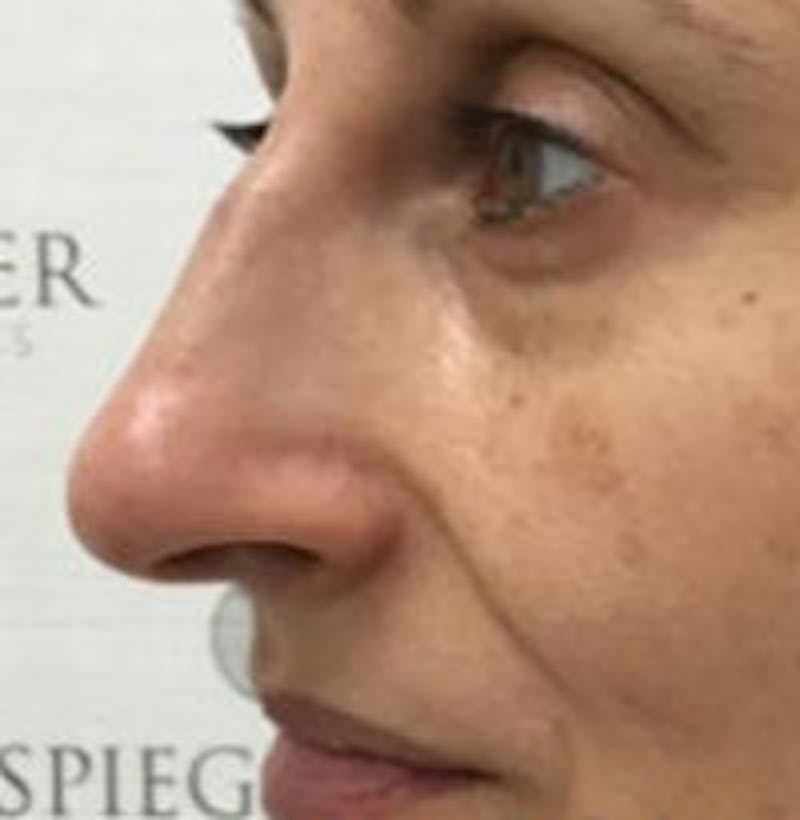 Non-Surgical Rhinoplasty / Nose Filler Before & After Gallery - Patient 157140770 - Image 4