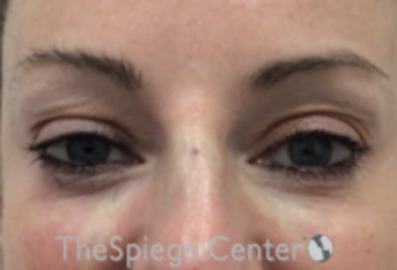 Tear Trough / Under Eye Fillers Before & After Gallery - Patient 157140777 - Image 2
