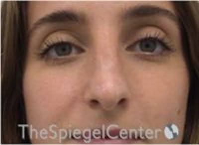 Non-Surgical Rhinoplasty / Nose Filler Before & After Gallery - Patient 157140778 - Image 1