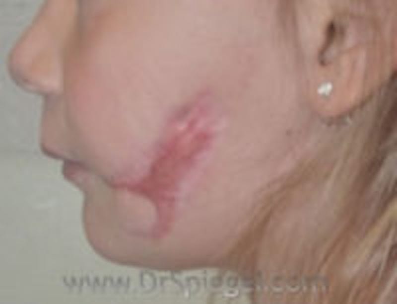 Scar Revision Before & After Gallery - Patient 157140776 - Image 1