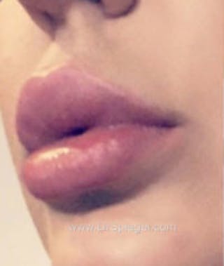 Lip Filler Before & After Gallery - Patient 157140774 - Image 4