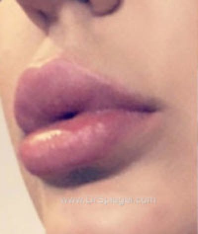 Lip Filler Before & After Gallery - Patient 157140774 - Image 4