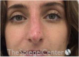 Non-Surgical Rhinoplasty / Nose Filler Before & After Gallery - Patient 157140778 - Image 2