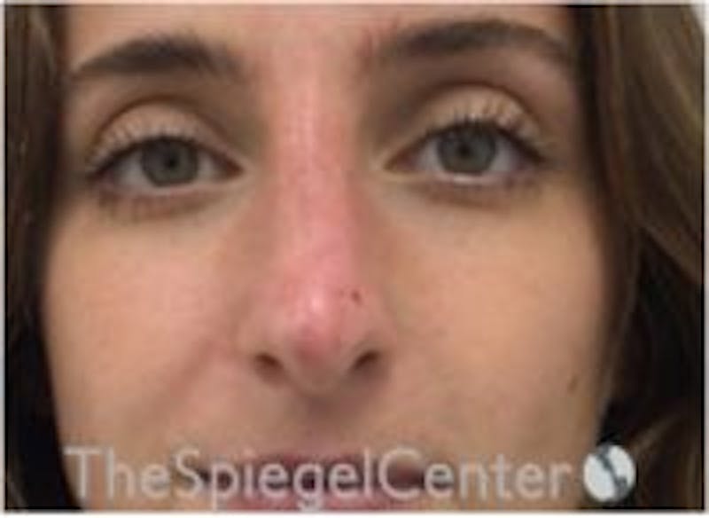 Non-Surgical Rhinoplasty / Nose Filler Before & After Gallery - Patient 157140778 - Image 2