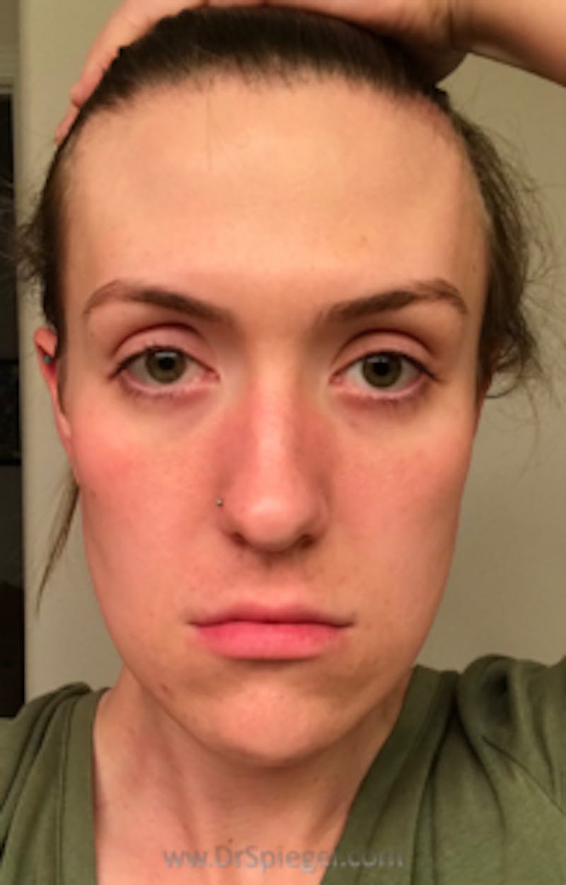 FFS Before & After Gallery - Patient 157140779 - Image 1