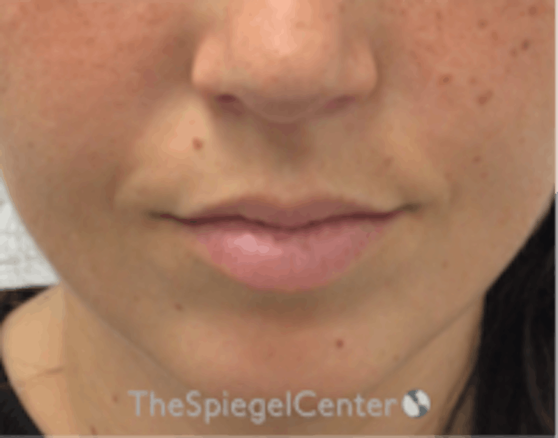 Lip Filler Before & After Gallery - Patient 157140783 - Image 1