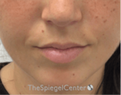 Lip Filler Before & After Gallery - Patient 157140783 - Image 1
