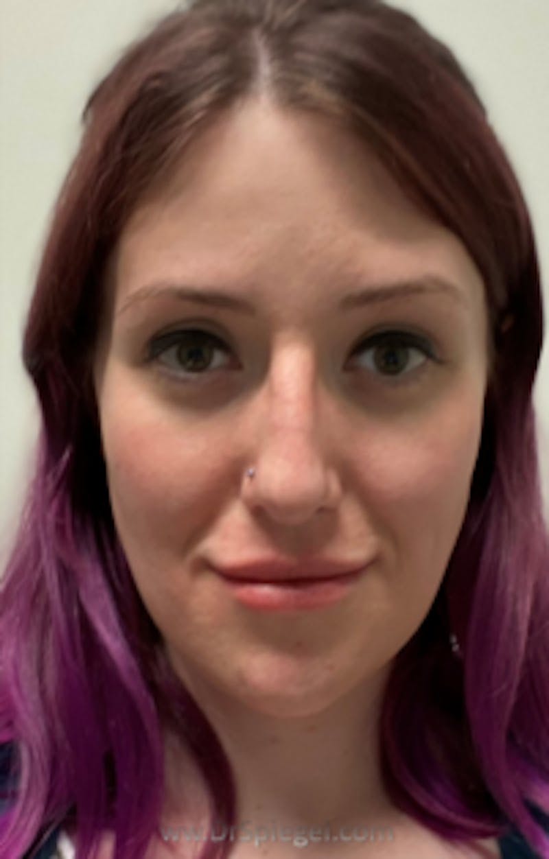 FFS Before & After Gallery - Patient 157140779 - Image 2