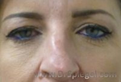 Tear Trough / Under Eye Fillers Before & After Gallery - Patient 157140782 - Image 1