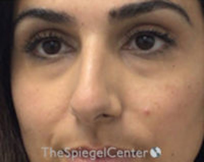Non-Surgical Rhinoplasty / Nose Filler Before & After Gallery - Patient 157140785 - Image 1