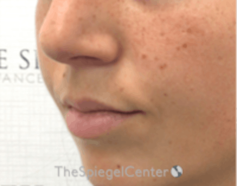 Lip Filler Before & After Gallery - Patient 157140783 - Image 3