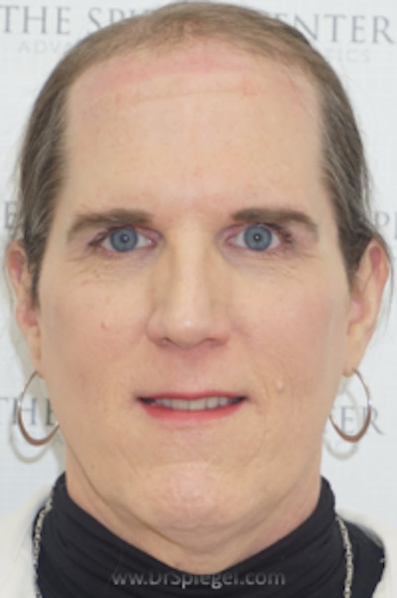 FFS Before & After Gallery - Patient 157140784 - Image 1