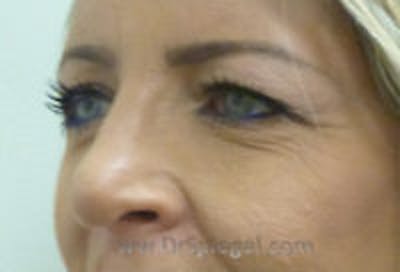 Tear Trough / Under Eye Fillers Before & After Gallery - Patient 157140782 - Image 3
