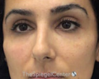 Non-Surgical Rhinoplasty / Nose Filler Before & After Gallery - Patient 157140785 - Image 2