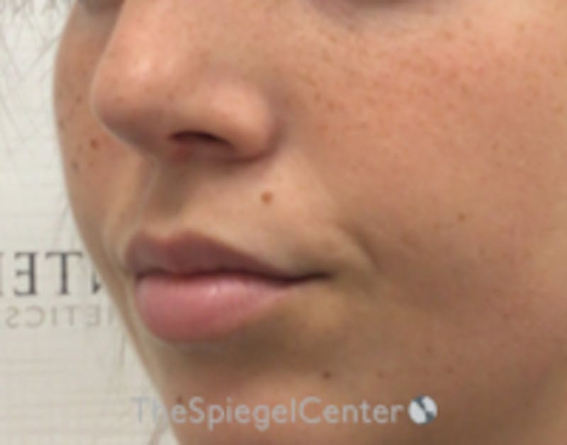Lip Filler Before & After Gallery - Patient 157140783 - Image 4