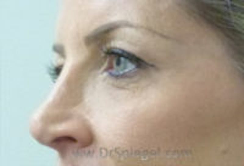 Tear Trough / Under Eye Fillers Before & After Gallery - Patient 157140782 - Image 4