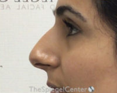Non-Surgical Rhinoplasty / Nose Filler Before & After Gallery - Patient 157140785 - Image 3