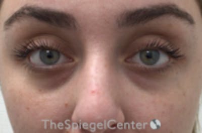 Tear Trough / Under Eye Fillers Before & After Gallery - Patient 157140789 - Image 1
