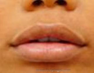 Lip Filler Before & After Gallery - Patient 157140790 - Image 2