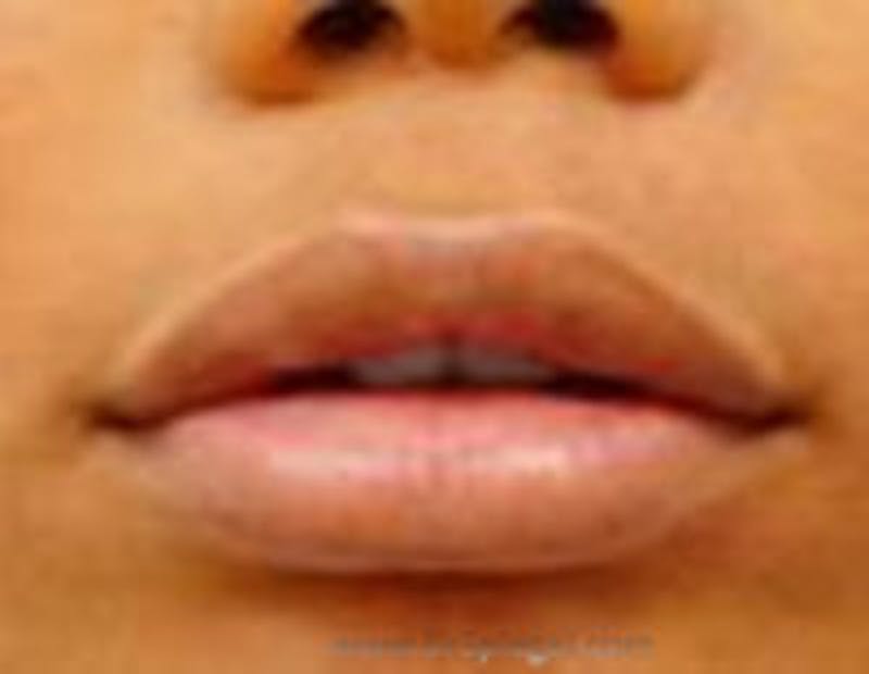 Lip Filler Before & After Gallery - Patient 157140790 - Image 2