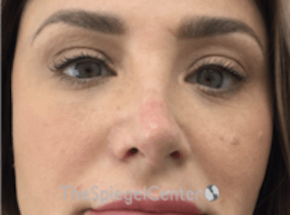 Non-Surgical Rhinoplasty / Nose Filler Before & After Gallery - Patient 157140792 - Image 2