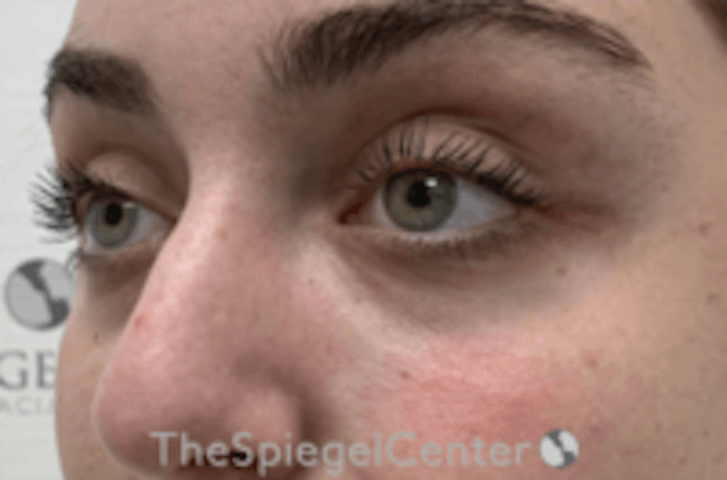 Tear Trough / Under Eye Fillers Before & After Gallery - Patient 157140789 - Image 4