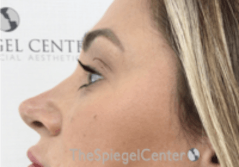 Non-Surgical Rhinoplasty / Nose Filler Before & After Gallery - Patient 157140792 - Image 4