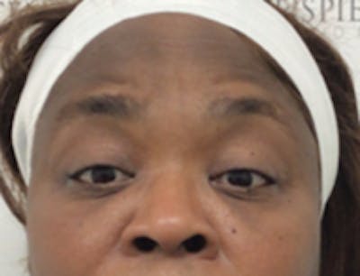 Tear Trough / Under Eye Fillers Before & After Gallery - Patient 157140798 - Image 1