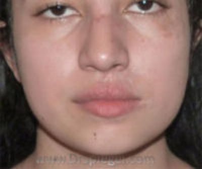 Scar Revision Before & After Gallery - Patient 157140793 - Image 2