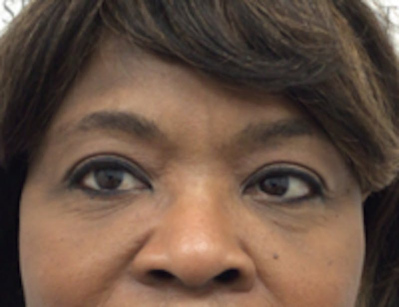 Tear Trough / Under Eye Fillers Before & After Gallery - Patient 157140798 - Image 2