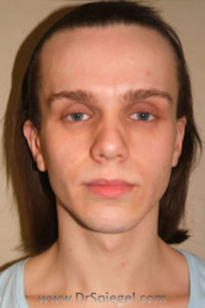 FFS Before & After Gallery - Patient 157140799 - Image 1