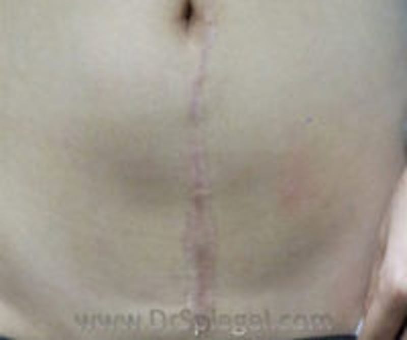 Scar Revision Before & After Gallery - Patient 157140797 - Image 2