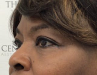 Tear Trough / Under Eye Fillers Before & After Gallery - Patient 157140798 - Image 4