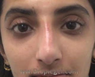 Non-Surgical Rhinoplasty / Nose Filler Before & After Gallery - Patient 157140800 - Image 2