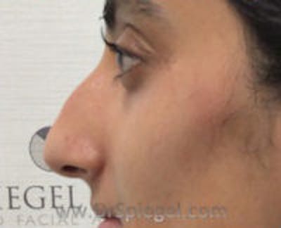Non-Surgical Rhinoplasty / Nose Filler Before & After Gallery - Patient 157140800 - Image 3