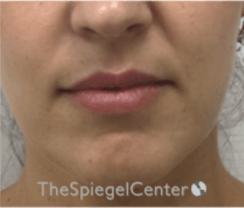Lip Filler Before & After Gallery - Patient 157140803 - Image 1
