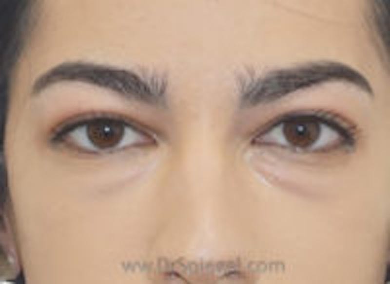 Tear Trough / Under Eye Fillers Before & After Gallery - Patient 157140804 - Image 1