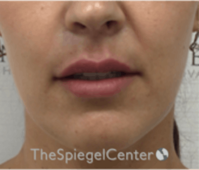 Lip Filler Before & After Gallery - Patient 157140803 - Image 2