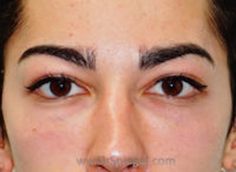 Tear Trough / Under Eye Fillers Before & After Gallery - Patient 157140804 - Image 2