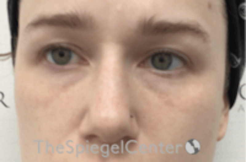 Non-Surgical Rhinoplasty / Nose Filler Before & After Gallery - Patient 157140806 - Image 1