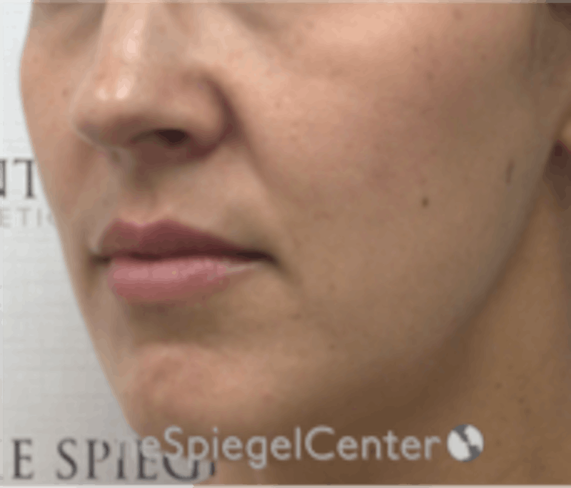 Lip Filler Before & After Gallery - Patient 157140803 - Image 3