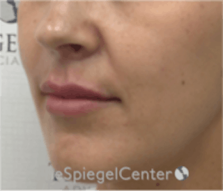 Lip Filler Before & After Gallery - Patient 157140803 - Image 4